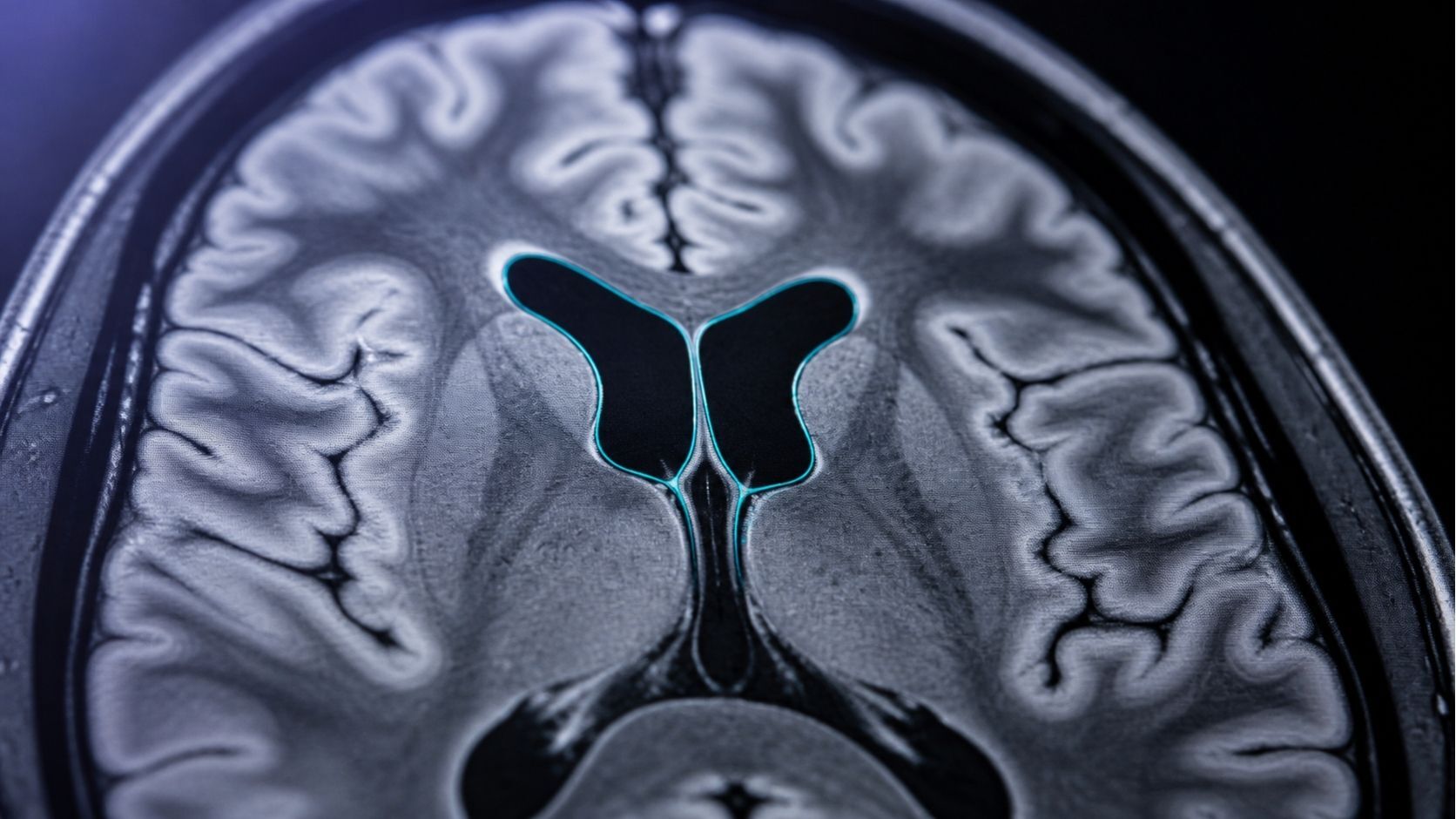 An axial brain MRI slice with the ventricles outlined